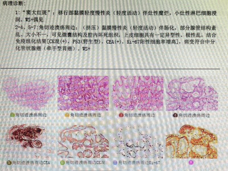 堵德水胃镜3病理.jpg