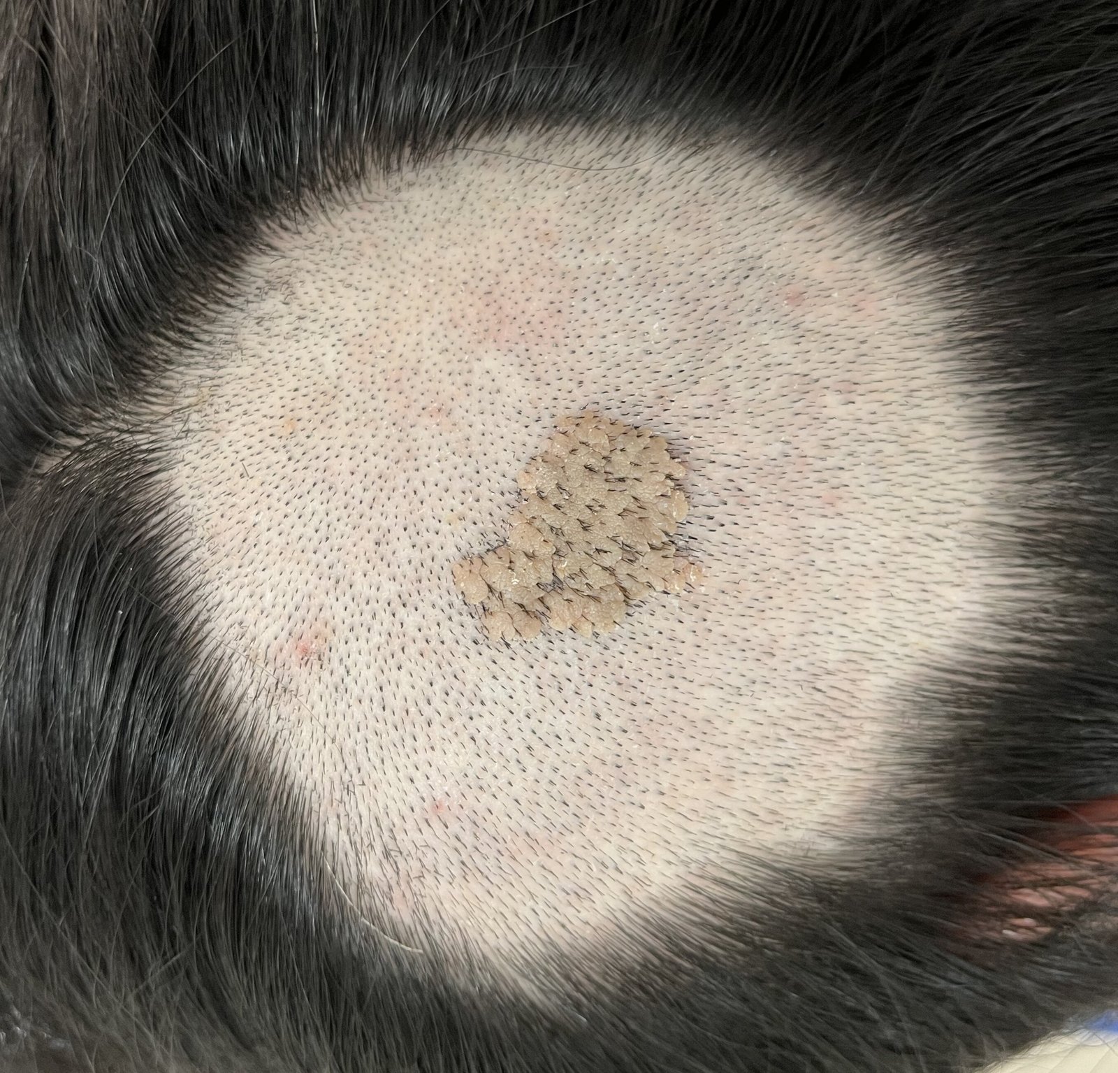 头皮皮脂腺痣一例