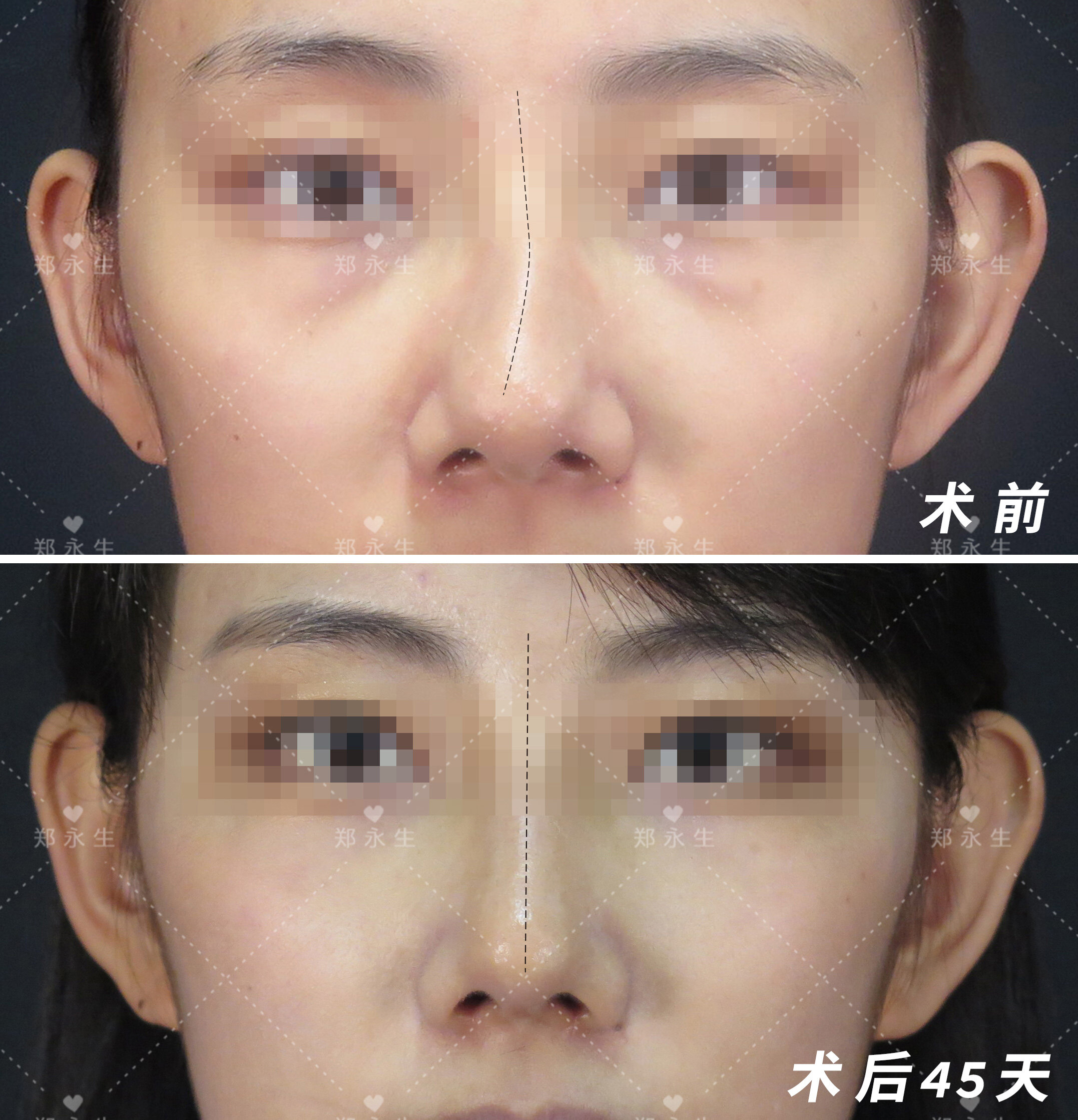 歪鼻矫正:手术选择开放式还是闭合式