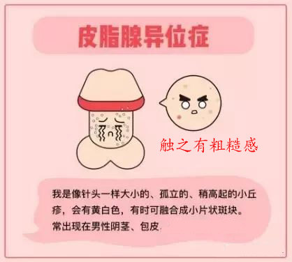 男性外生殖器 龟头阴茎阴囊 异常症状 阴茎多发丘疹 皮脂腺异位症 Fordyce病 皮脂腺囊肿