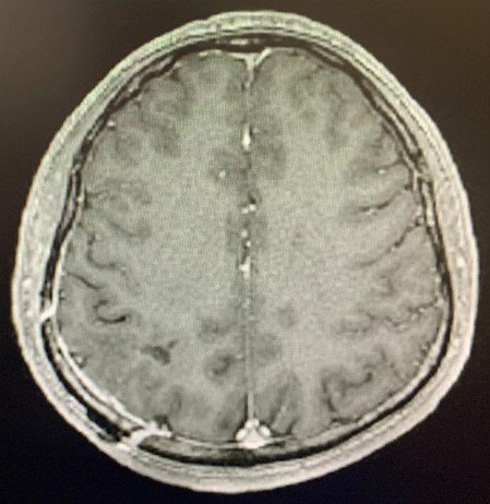 中央區腦轉移瘤可以手術切除嗎?