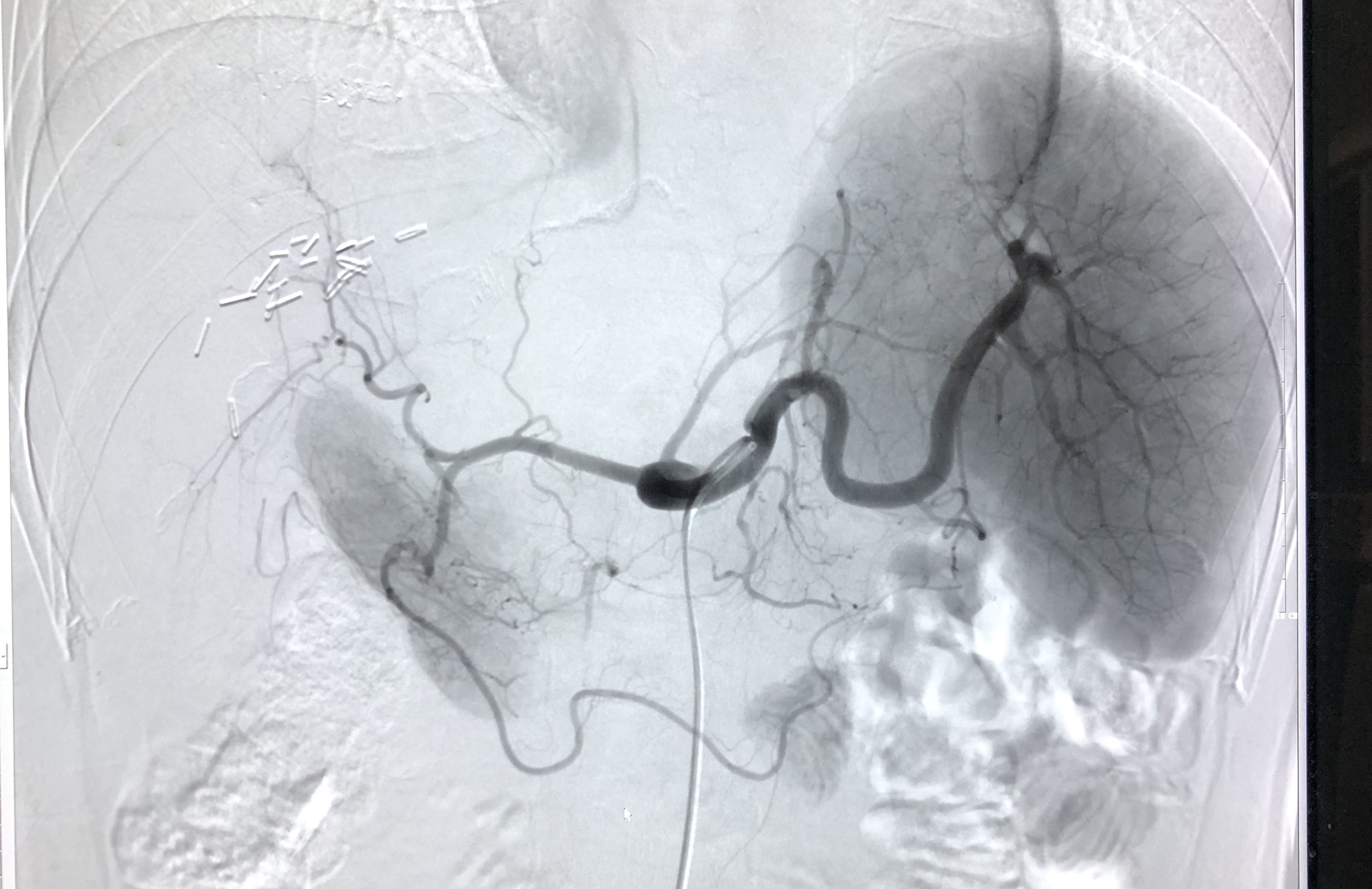 经肝动脉造影可见门脉癌栓染色,行载药微球栓塞治疗.