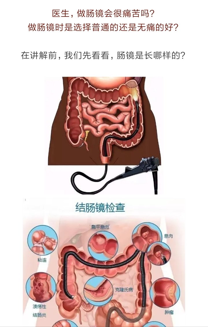 胃肠镜检查过程示意图图片