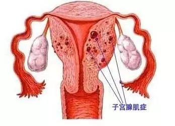 得了子宫腺肌症怎么办 子宫腺肌症 子宫腺肌症
