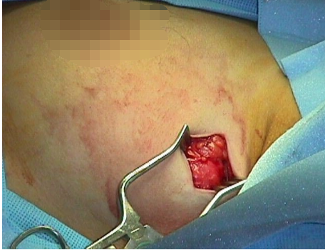 乳房肿瘤切除手术图片图片