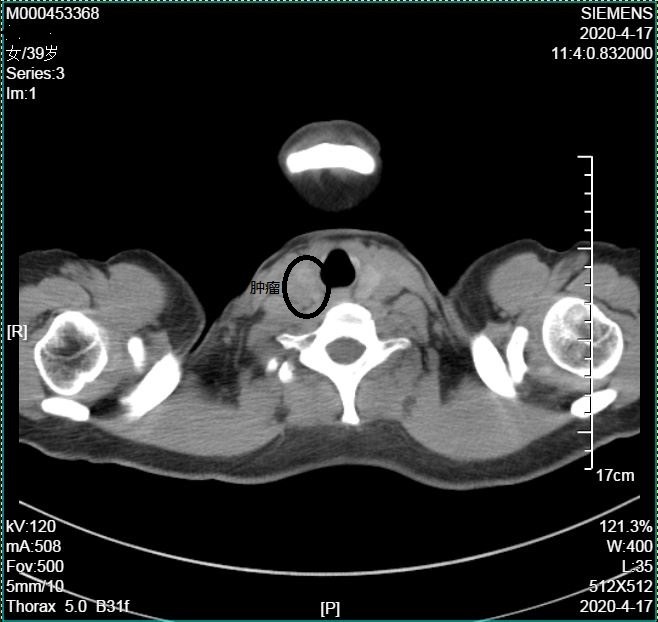 甲状腺癌_甲状腺癌治疗方式 - 好大夫在线