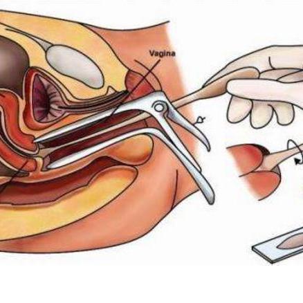【手把手教你看懂检查报告系列】宫颈防癌涂片 tct_宫颈癌_宫颈癌检查