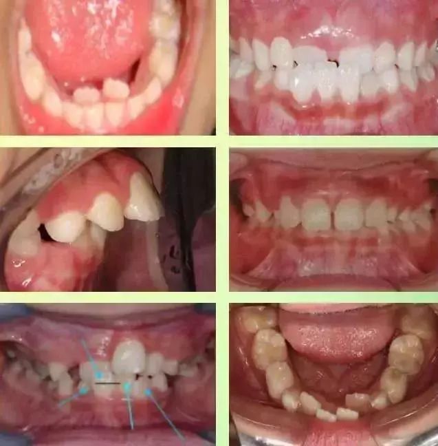 七岁是第一个牙齿矫正的黄金时期