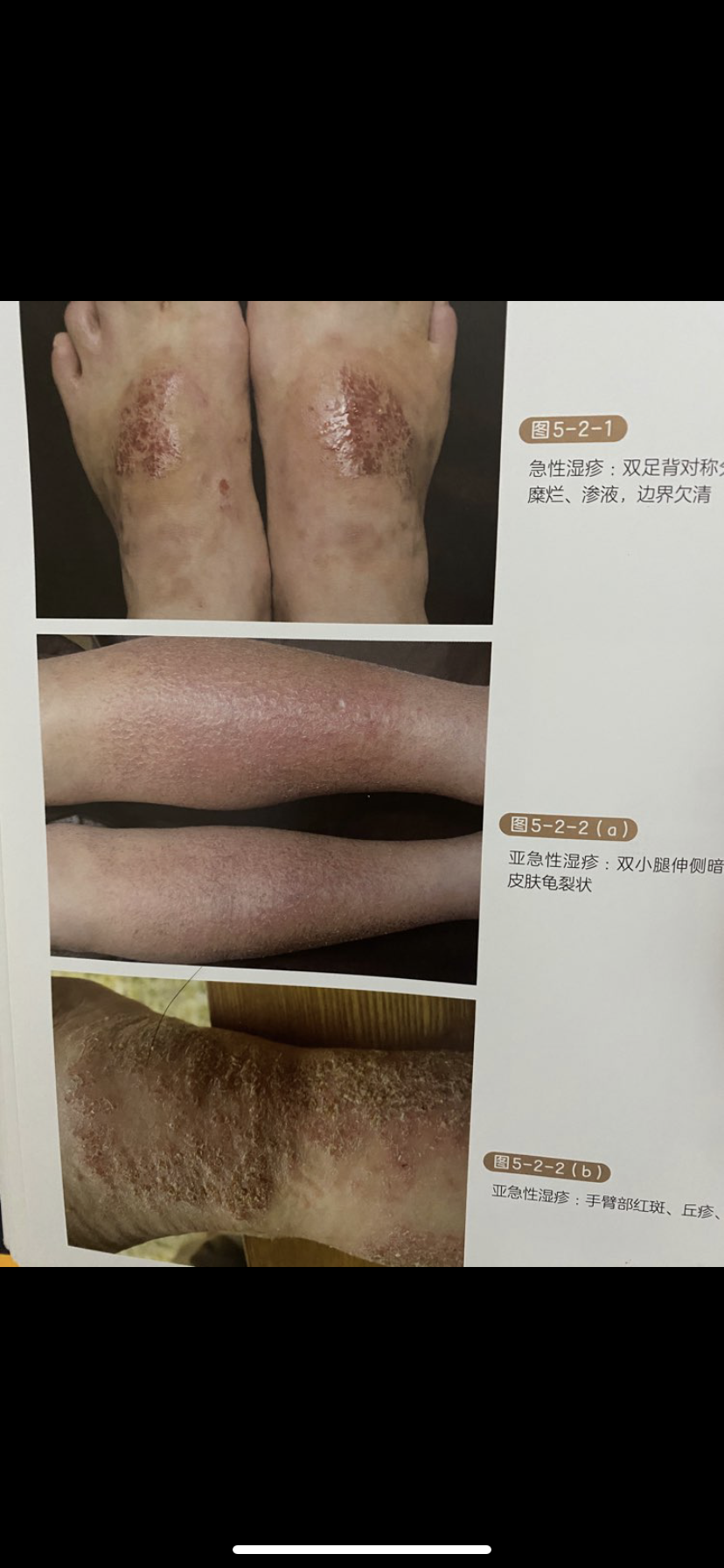 湿疹的治疗_湿疹 - 好大夫在线