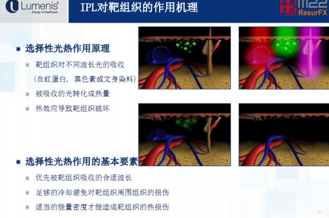 光子嫩肤(强脉冲光, ipl)_激光美容_激光美容治疗介绍 - 好大夫在线