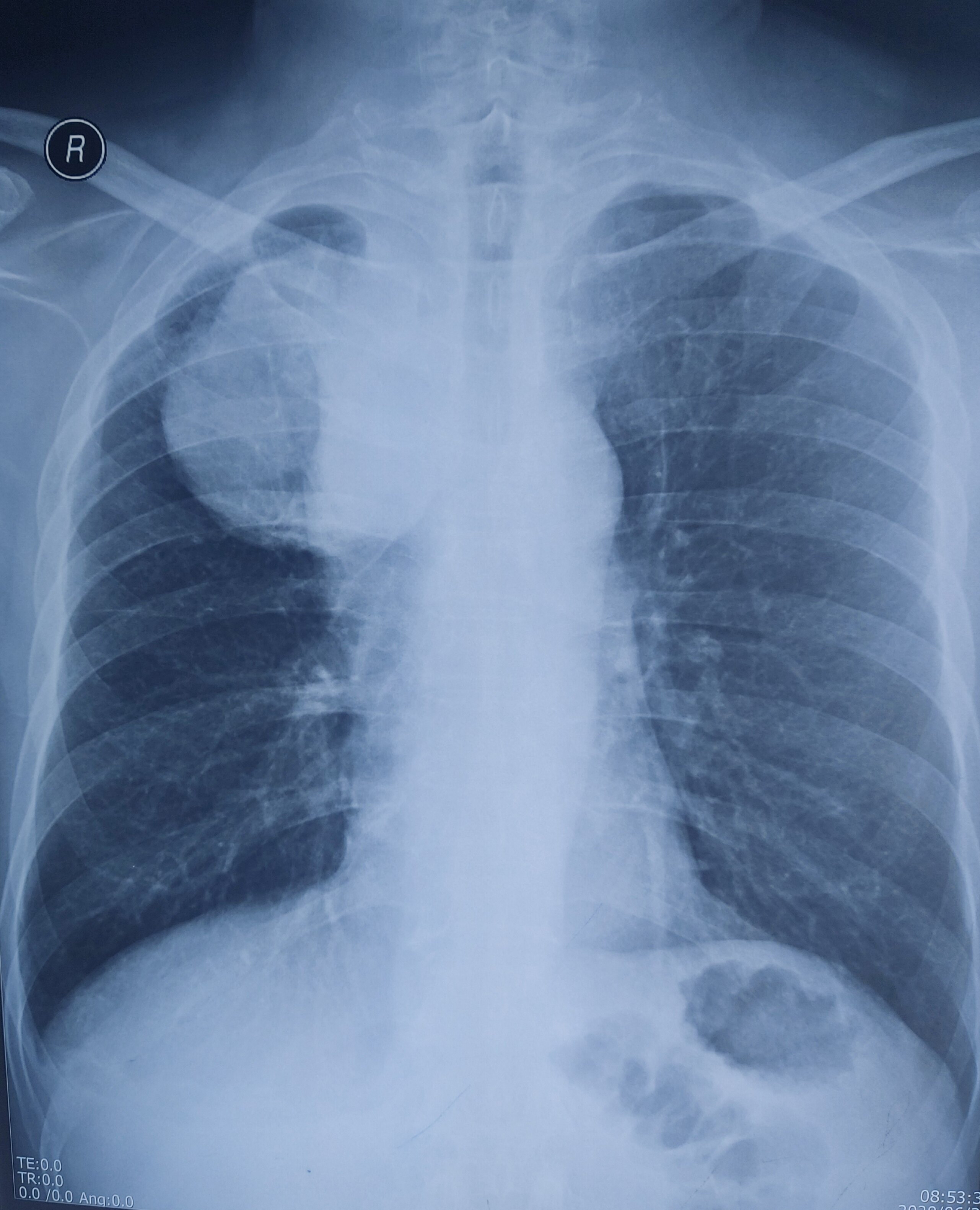肺癌的片子是啥样的图片