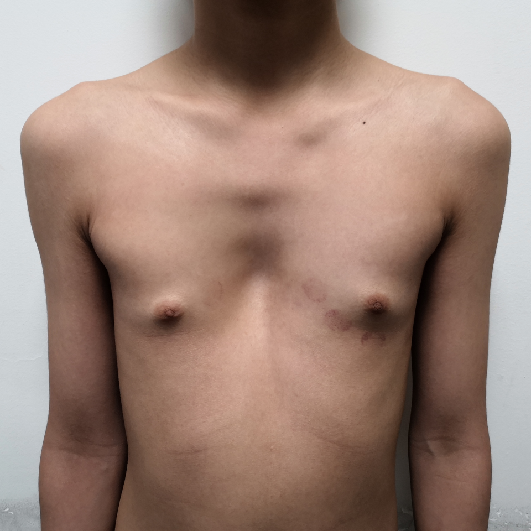 重度漏斗胸压迫心脏微创手术治疗 13岁男孩 漏斗胸 漏斗胸