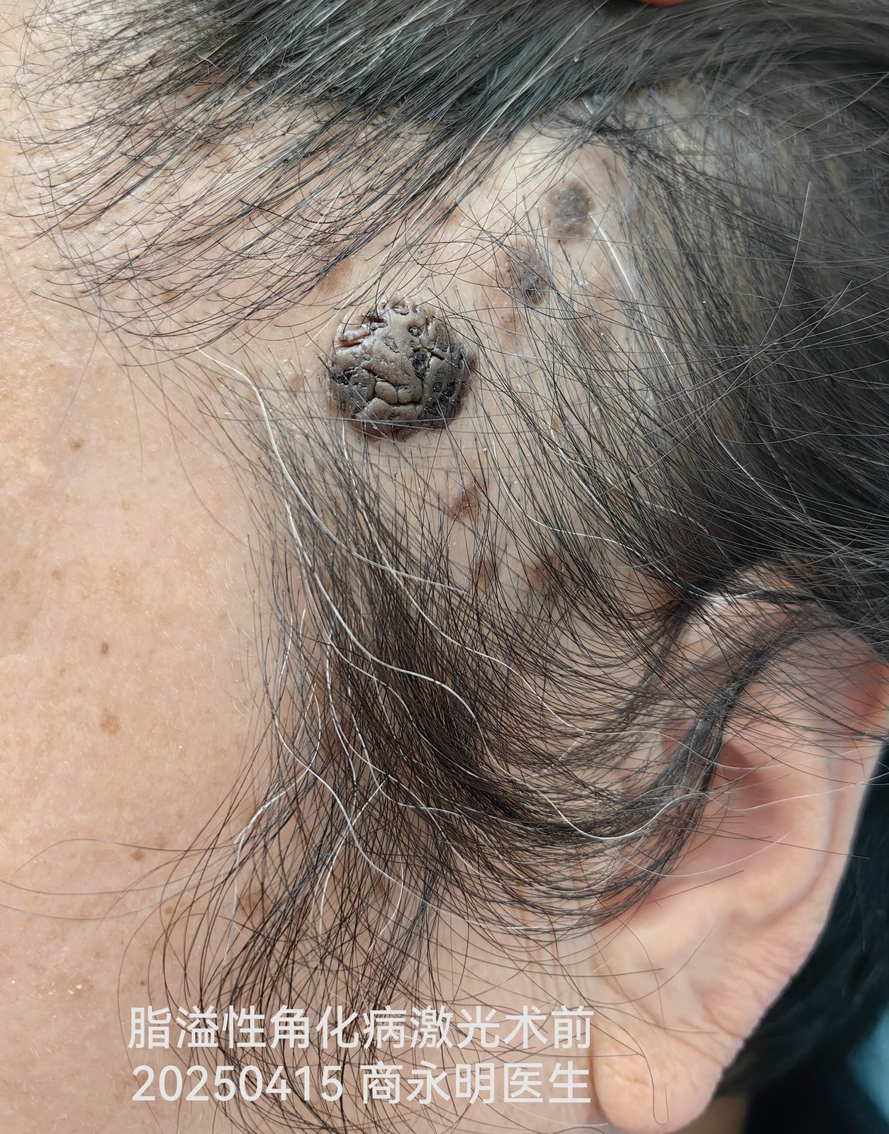 脂溢性角化病，激光可以搞定