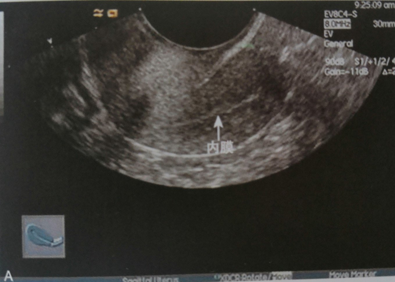 子宫内膜薄的彩超图片图片