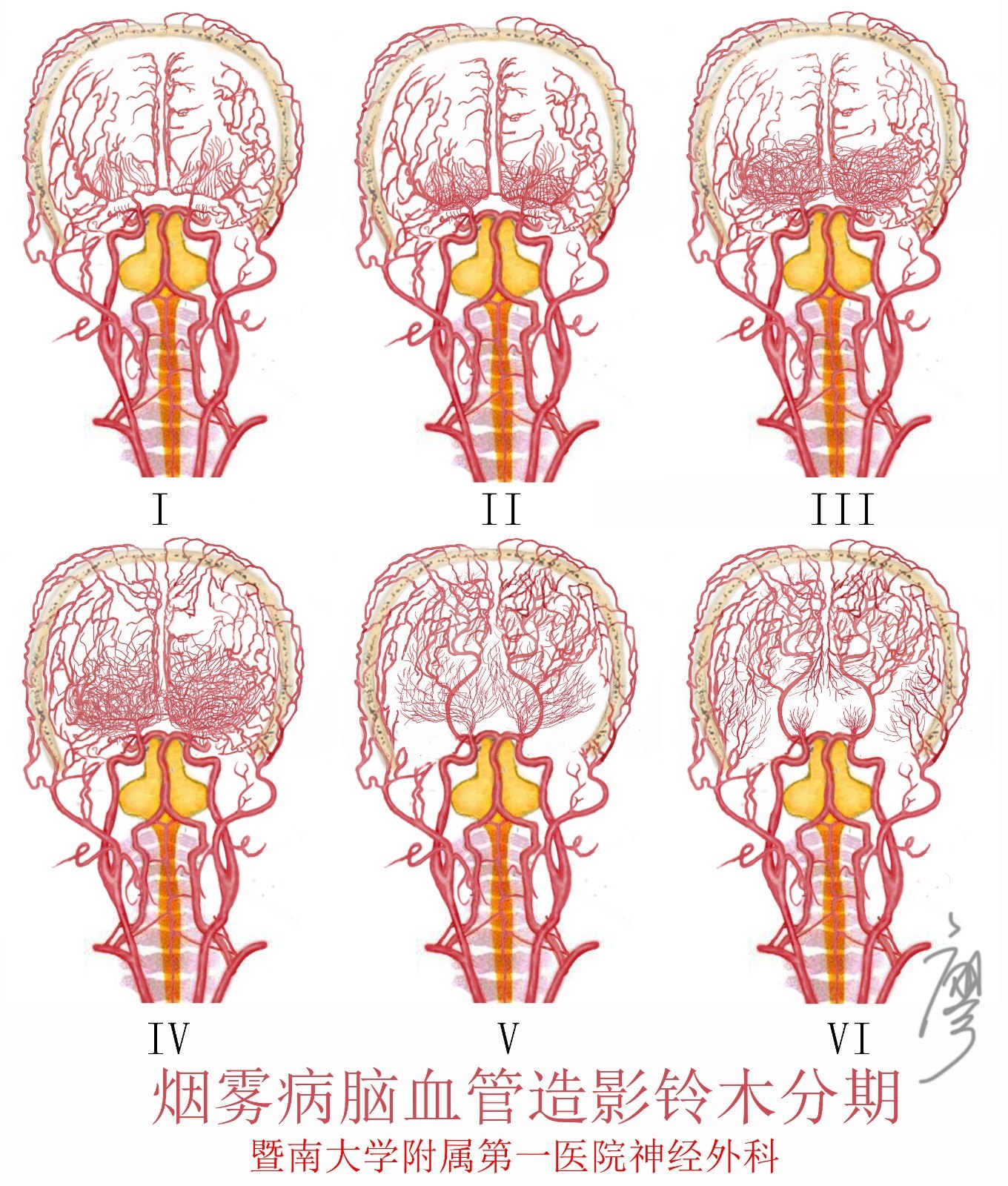 烟雾病脑血管造影铃木分期----图文结合一看就懂_烟雾病 - 好大夫在线