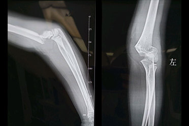 孩子滑滑板车摔倒就导致胳膊骨折了这可怎么办