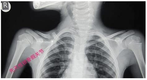 罕见病:锁骨假关节_先天性骨与关节畸形 好大夫在线