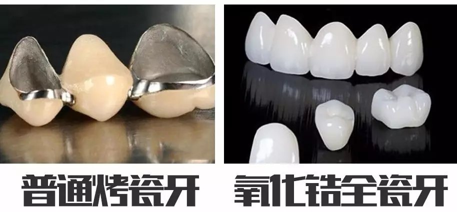 纯钛烤瓷牙套好吗_纯钛活动牙一颗价格_钛合金烤瓷牙价格