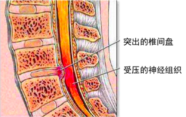 方突出壓迫神經產生相應神經症狀就是廣義上的腰椎間盤突出以及頸椎病