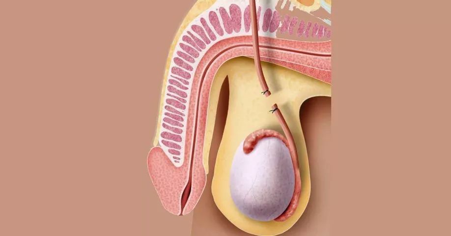 男性絕育輸精管結紮手術你準備好了嗎高端醫療