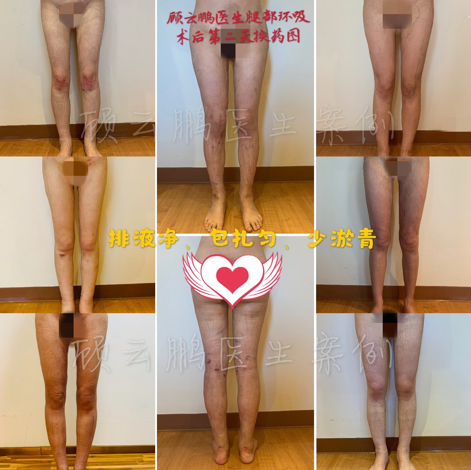 大腿 大小腿环吸的术后管理 必读 吸脂 吸脂护理及注意事项 好大夫在线 大腿 大小腿环吸的术后管理 必读 吸脂 吸脂护理及注意事项 好大夫在线