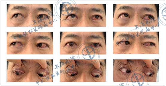 graves眼病系列病例⑦——斜视矫正术_graves眼病_graves眼病治疗方式