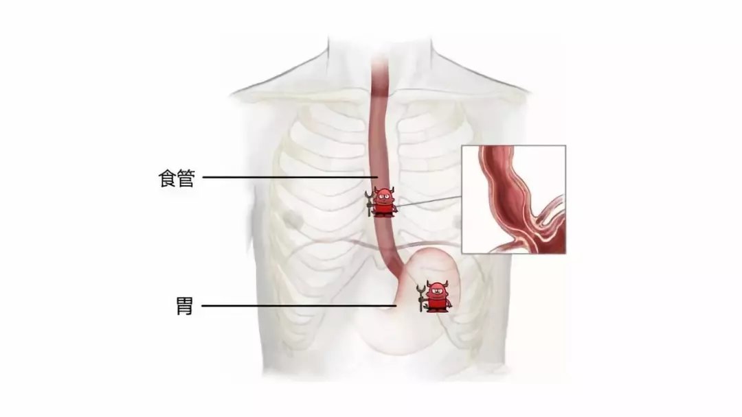 食管癌合併胃癌如何手術治療什麼是食管胃雙原發癌