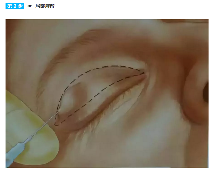 全切双眼皮手术设计全过程图解 - 好大夫在线