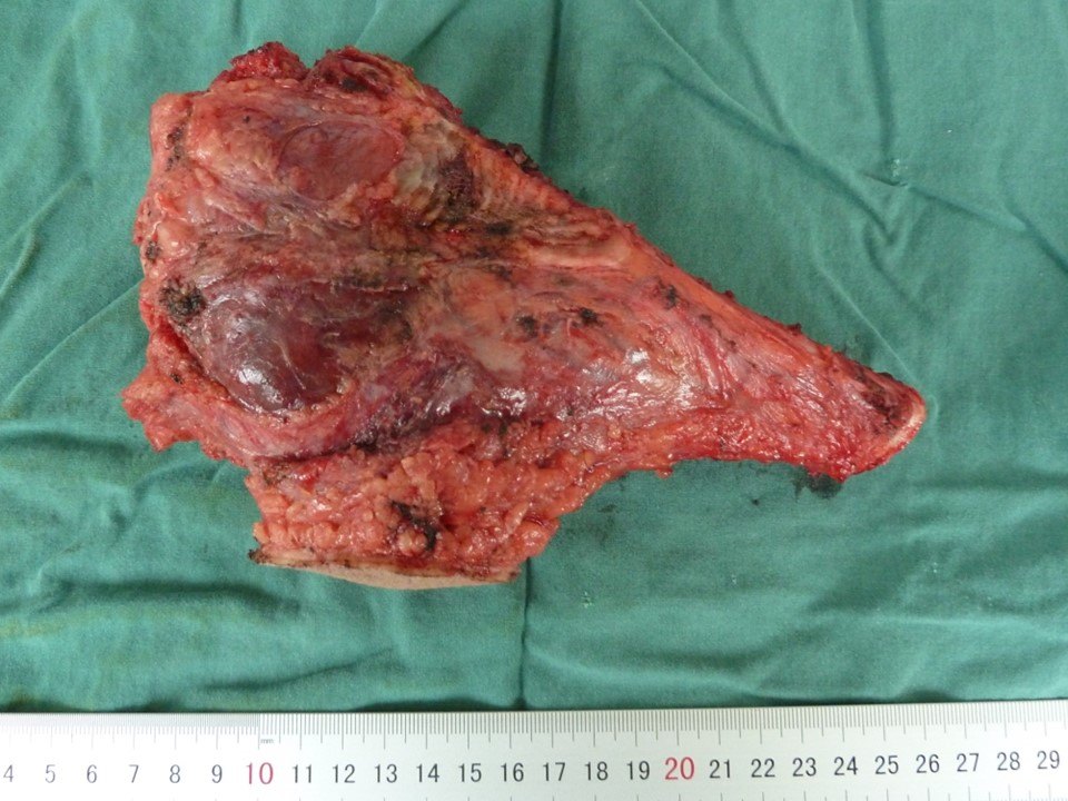 胫骨骨肉瘤--肿瘤型膝关节假体置换术 - 好大夫在线