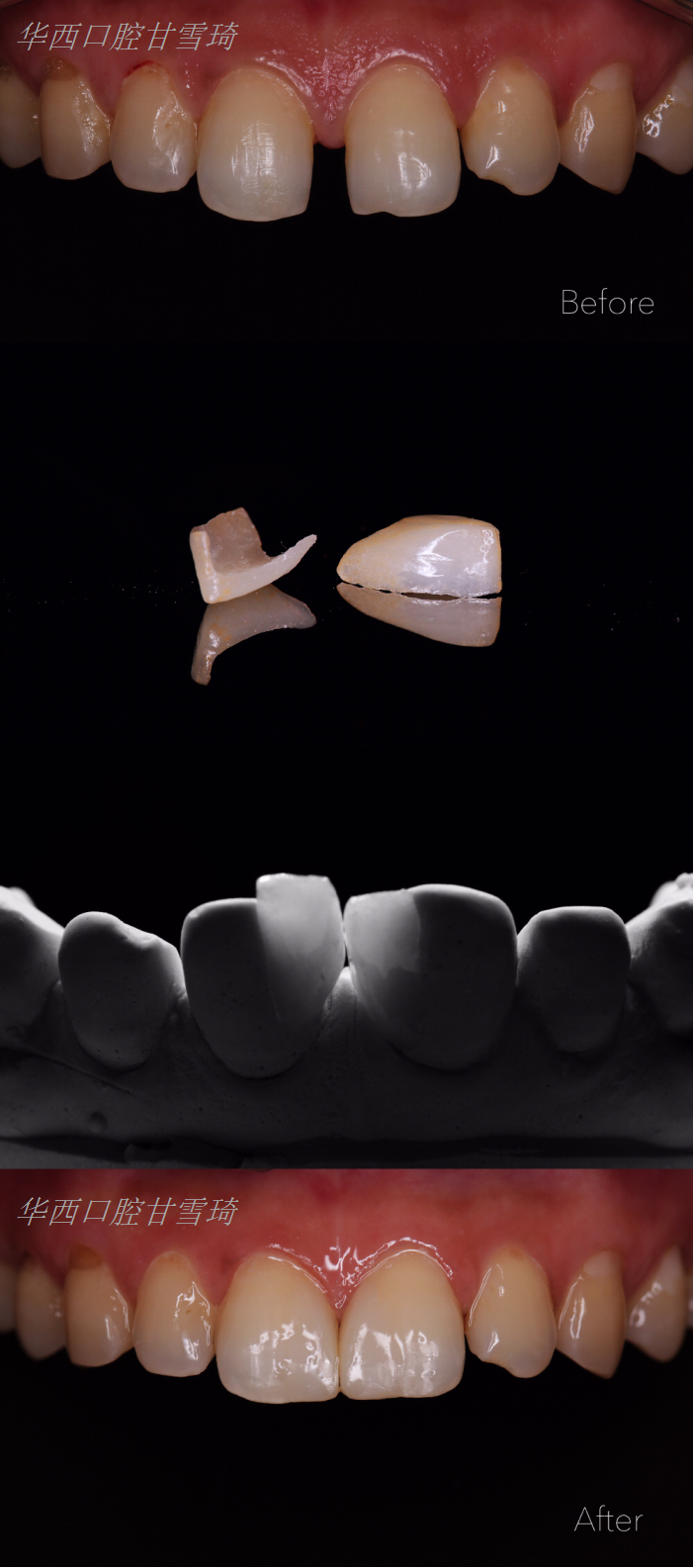 前牙间隙 无创贴面修复 - 好大夫在线