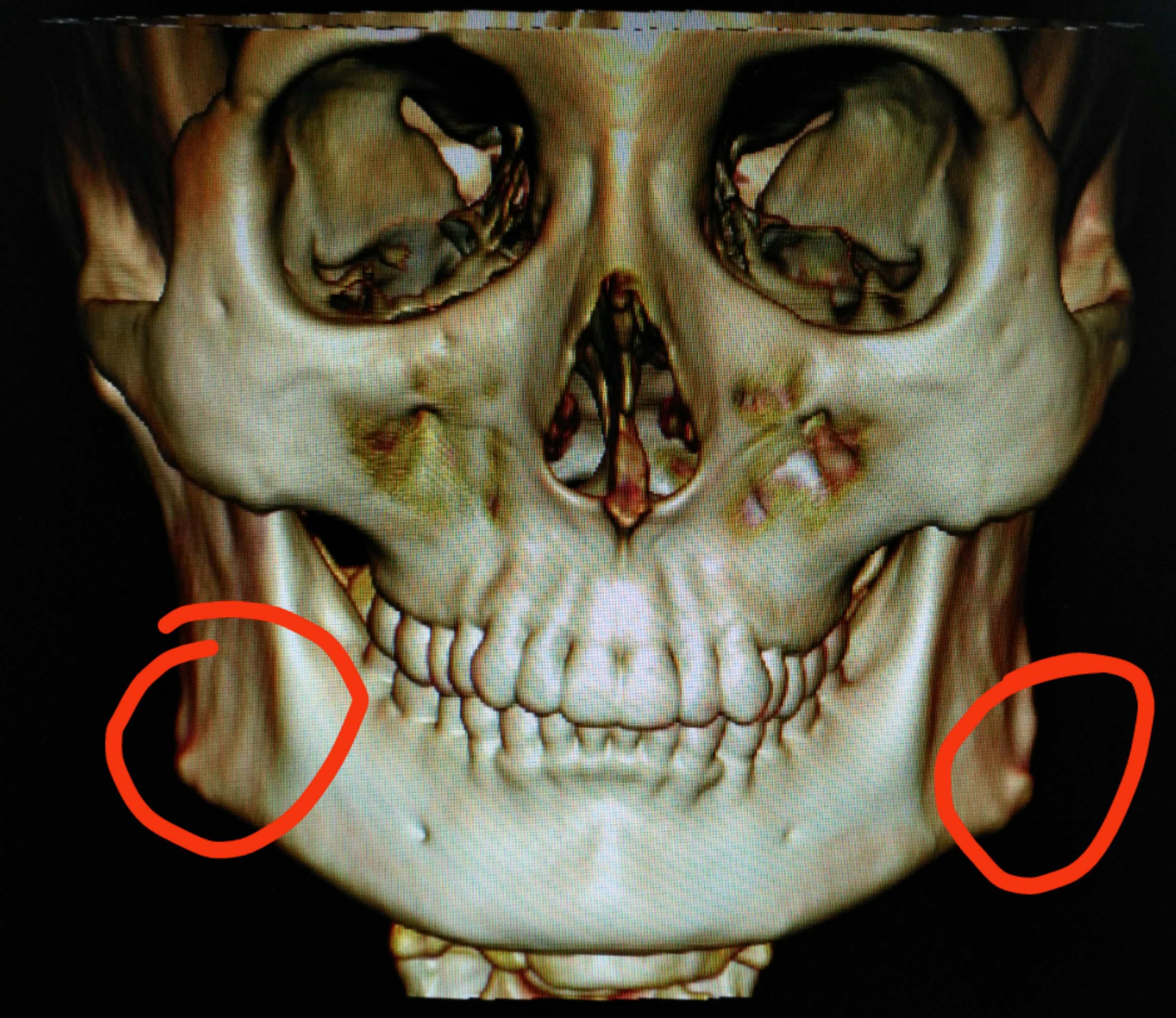 使面部下三分之一显得宽而阔,这就是所谓方脸形,也叫下颌角肥大