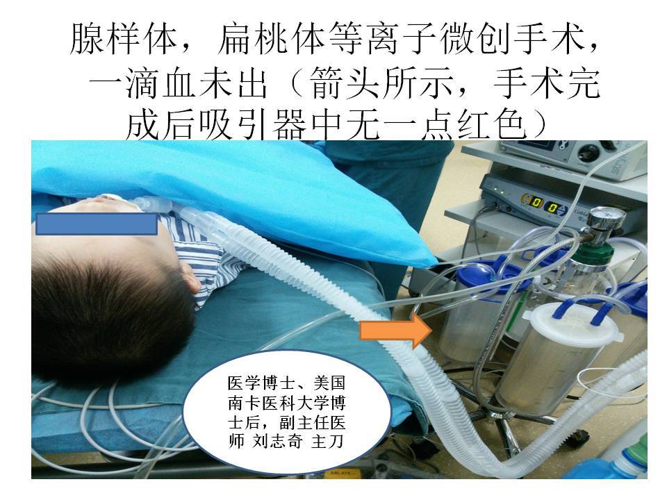不出血的腺样体,扁桃体手术