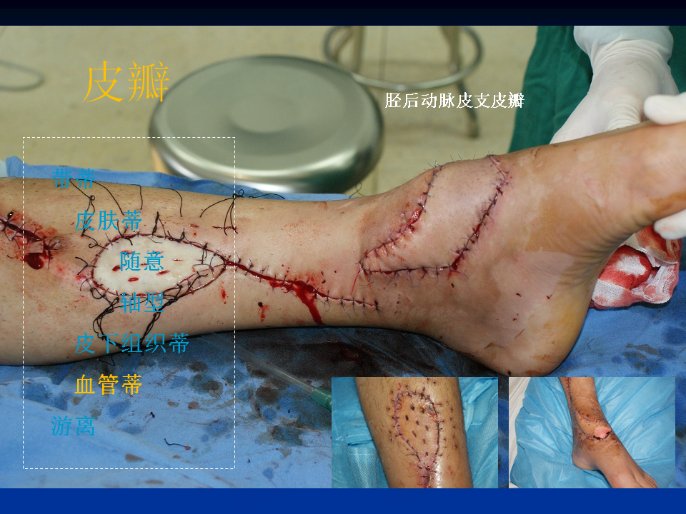 皮肤移植基本概念 - 好大夫在线