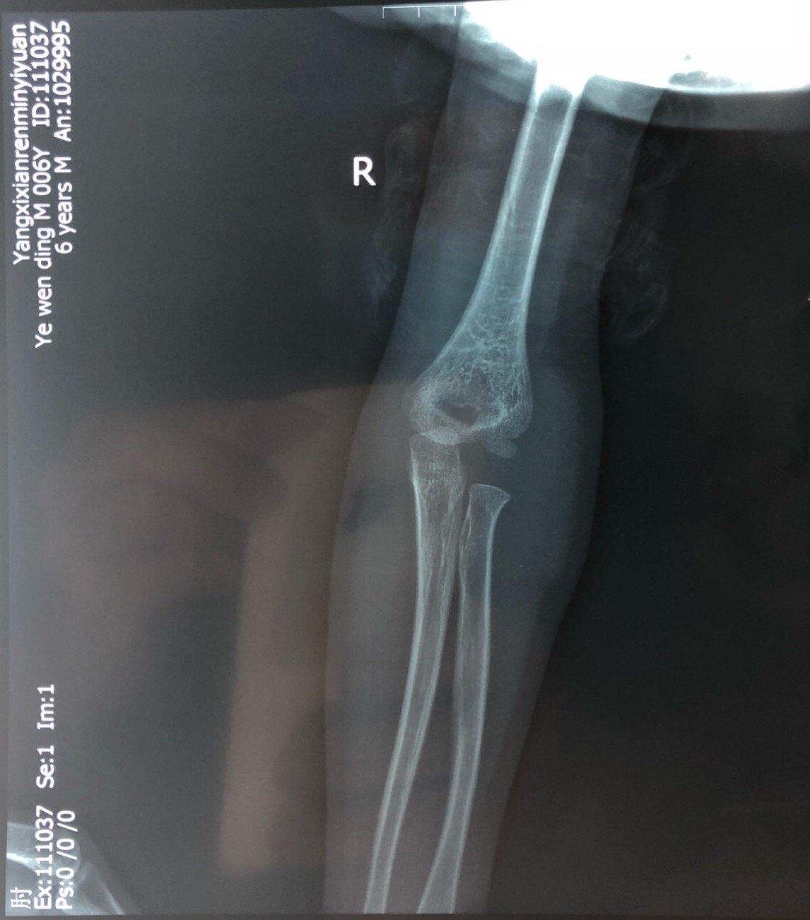 肱骨外髁骨折 www.haodf.com