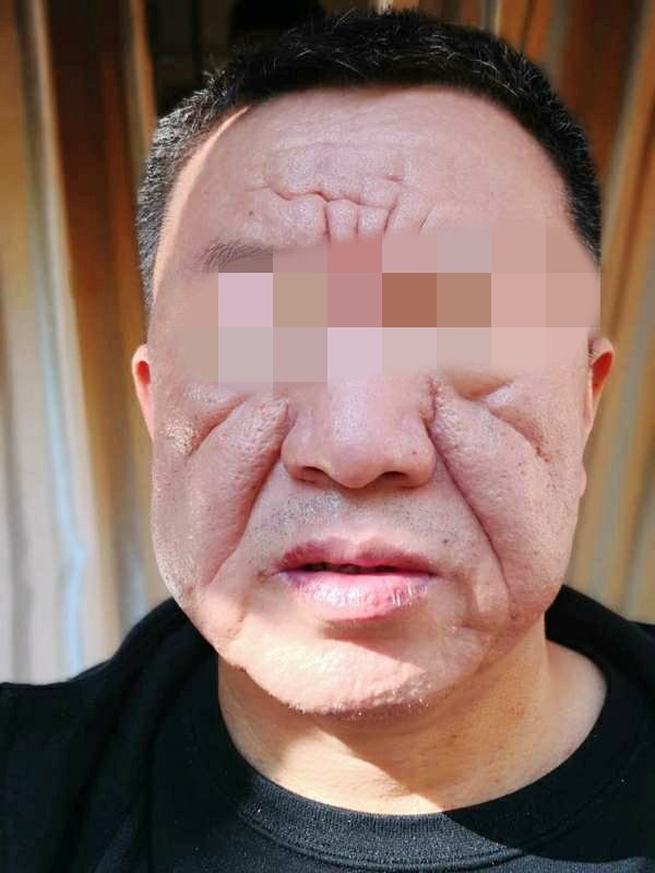 严重面部玫瑰痤疮治疗前后对比 - 好大夫在线