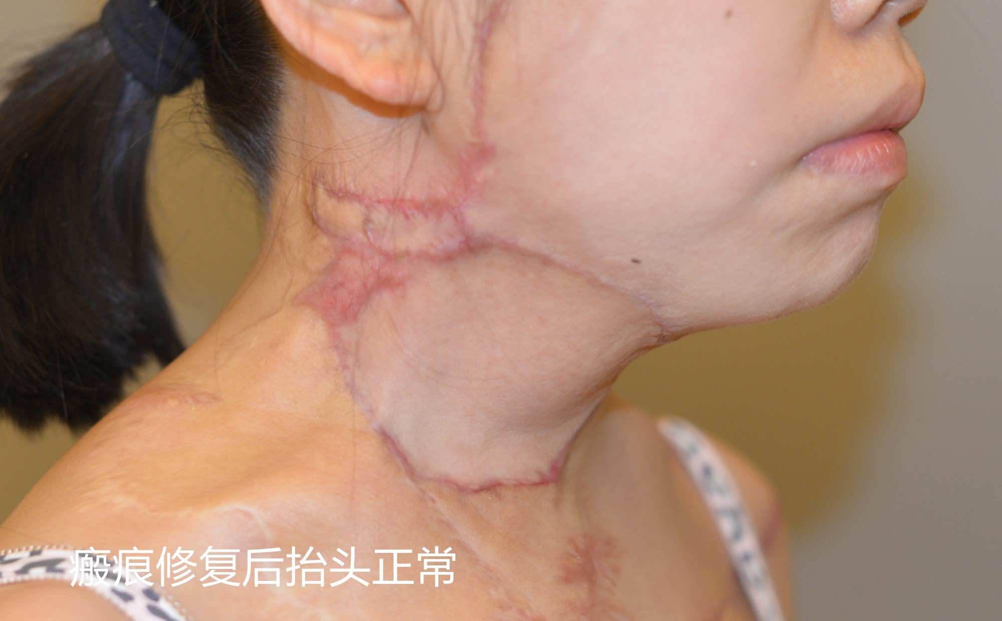 这是利用缓慢扩充皮肤面积的方法,将瘢痕皮肤去除后覆盖新皮肤,就如