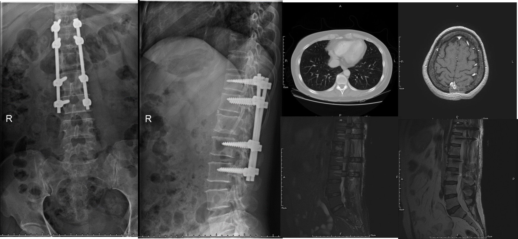 乳腺癌脊柱骨转移治疗成功病例1例分析 