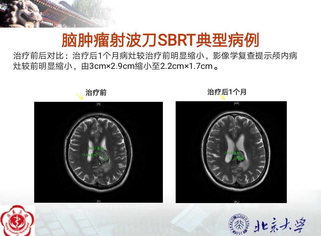 腦腫瘤射波刀放射治療良好療效典型病例