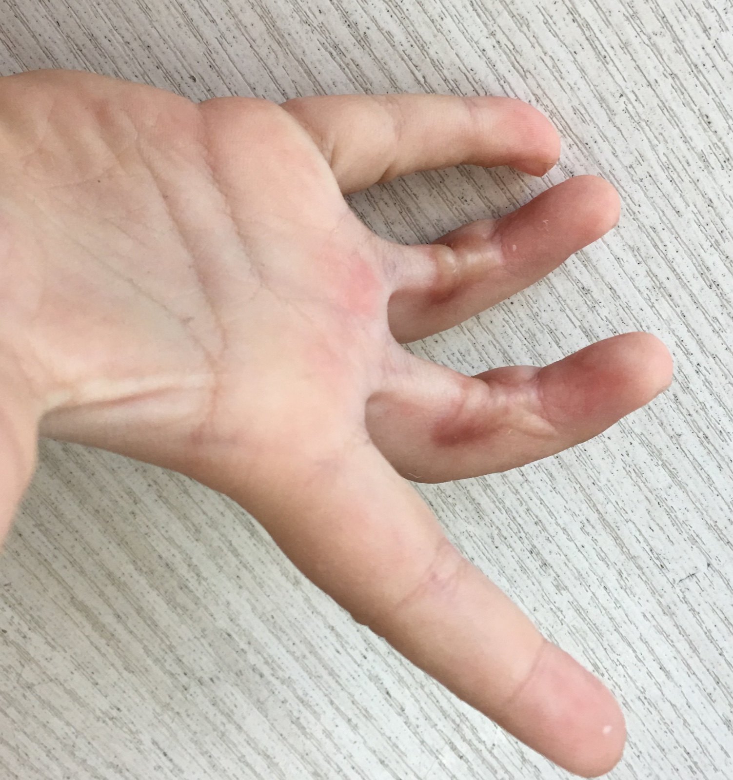 脫毛燙傷皮膚_手臂燙傷脫皮了會(huì)留疤嗎_