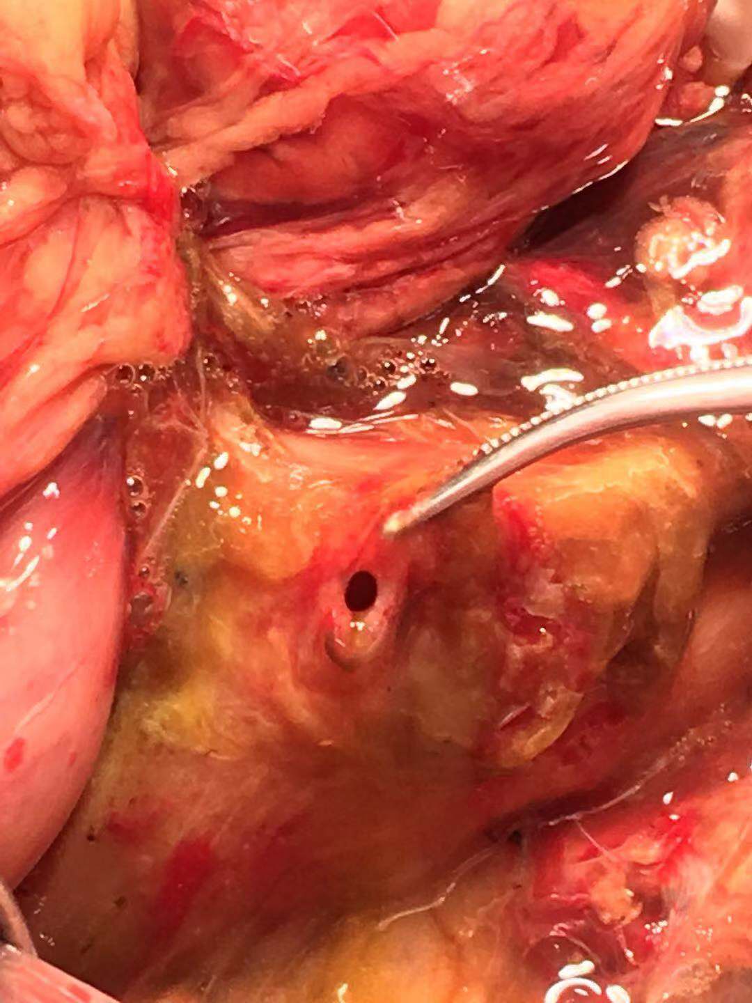 十二指肠破裂三造瘘并脾破裂血气胸多处骨折的全身多发伤