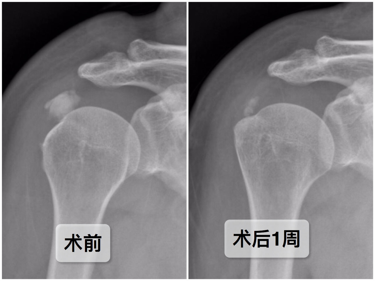 冈上肌腱钙化图片