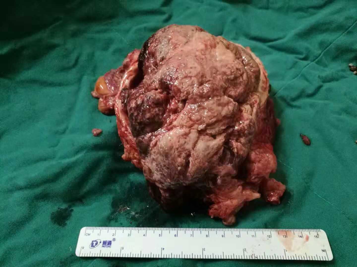 女性膀胱癌图片图片