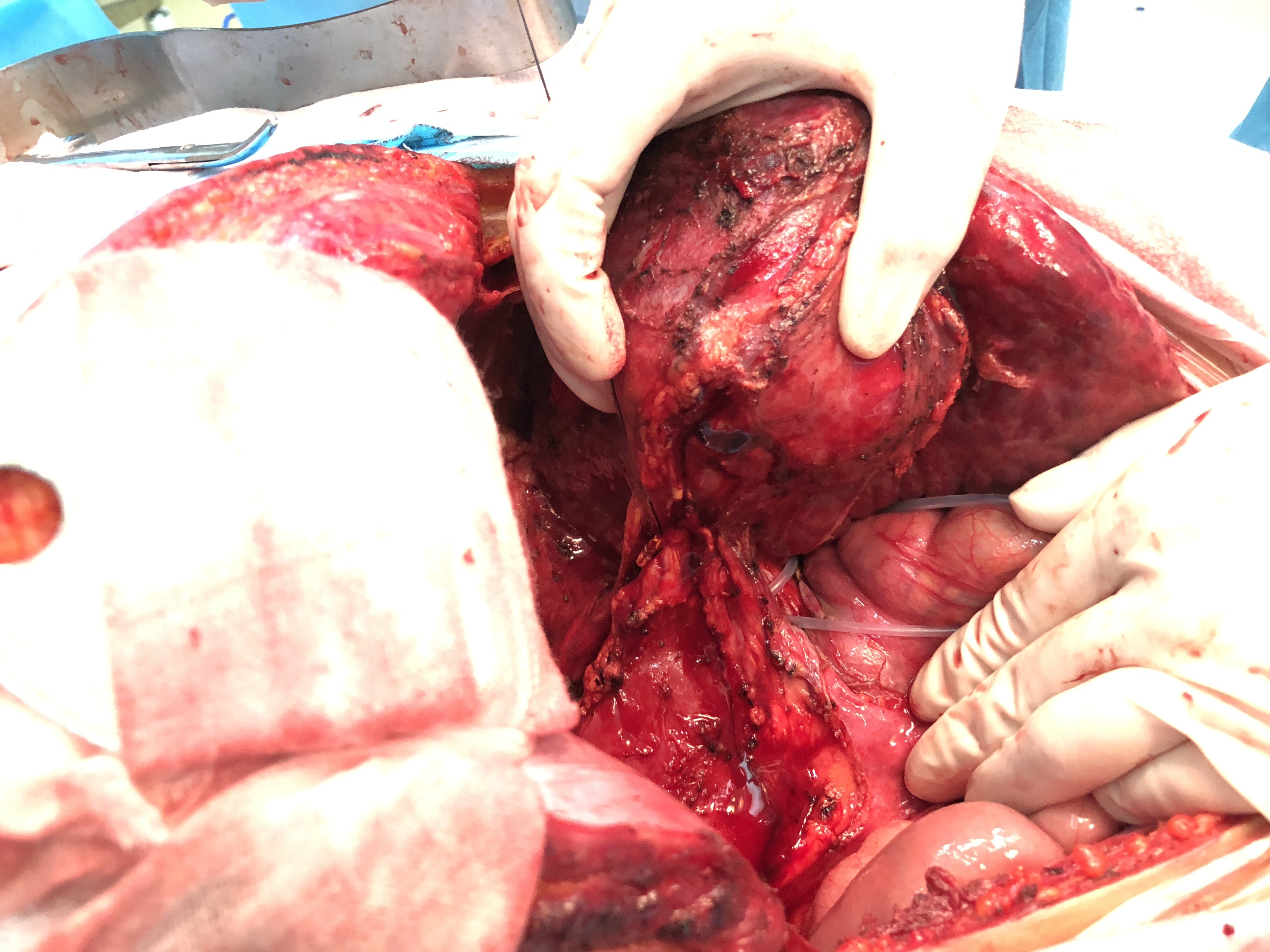 严重肝硬化肝癌连同浸润的膈肌和右肾脂肪囊切除手术