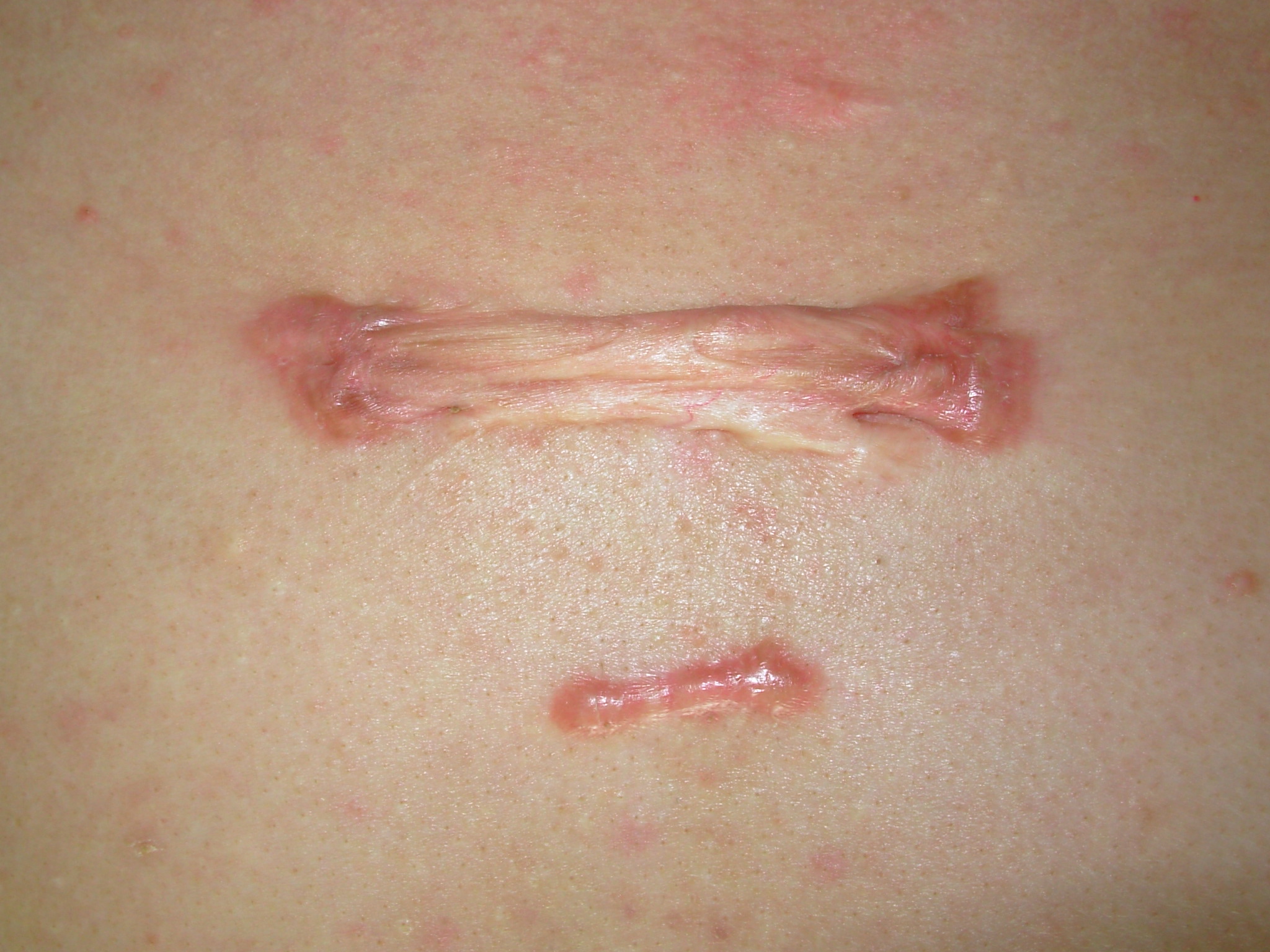 胸疤痕疙瘩怎样治疗图片