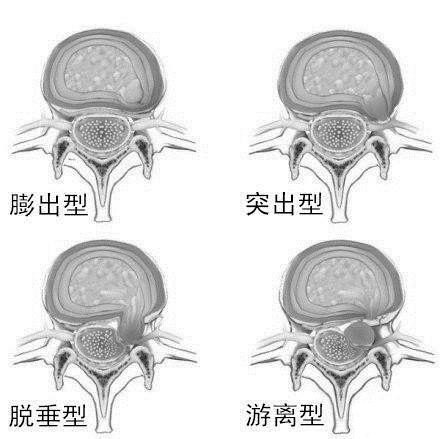 腰椎間盤突出的原理是什麼自身會吸收變小萎縮嗎