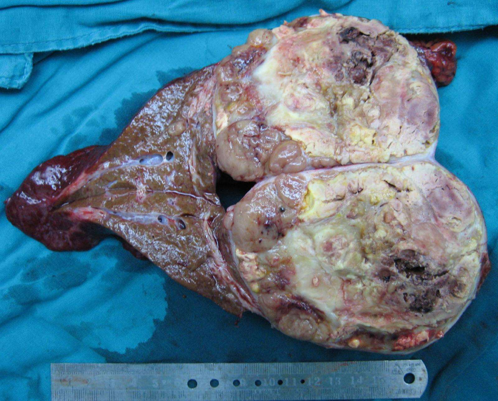 左半肝切除治疗原发性肝癌s3s4