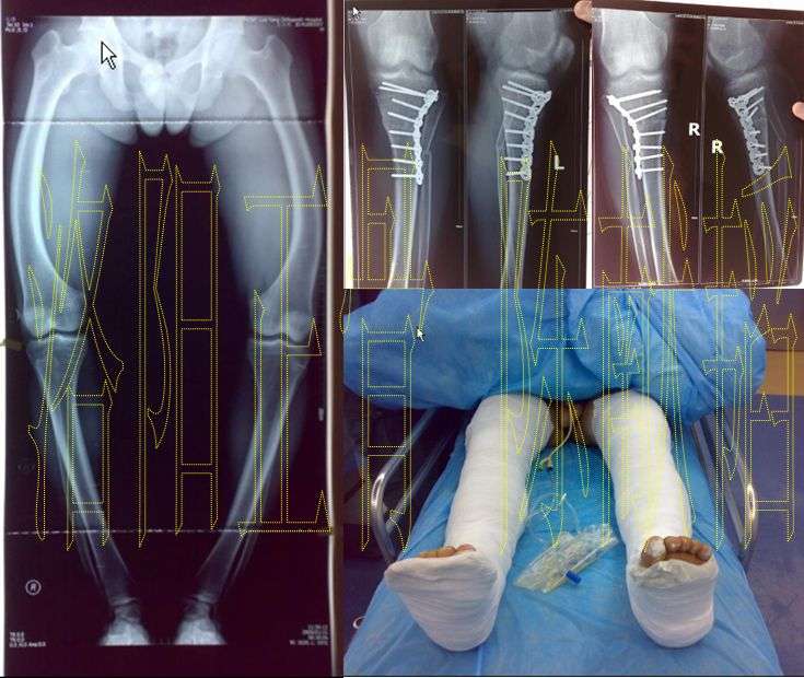 手术矫正腿型图片