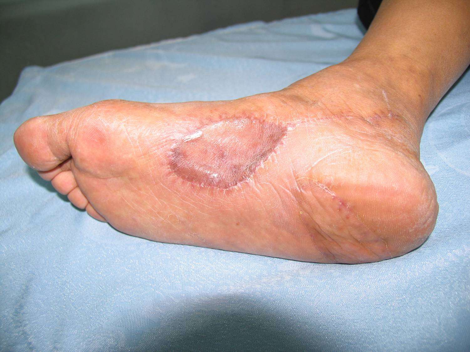 小腿足踝部皮肤缺损创面的修复