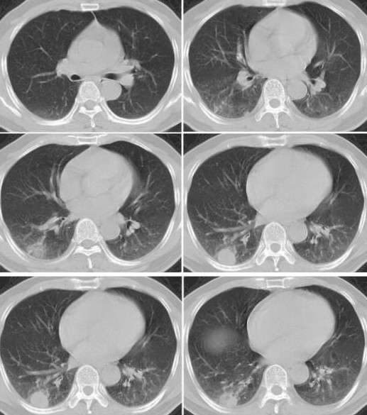 球形肺炎(网络远程会诊病例) - 好大夫在线