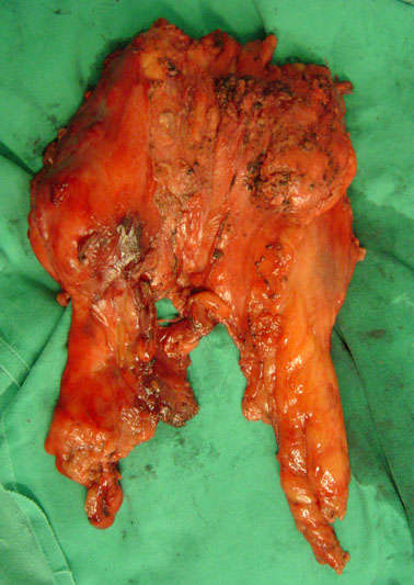 巨大纵隔肿瘤,胸腺癌 - 好大夫在线